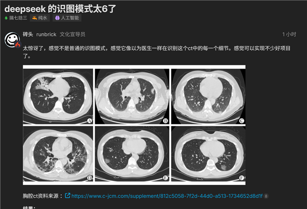 新版DeepSeek来袭 识图能力太强：能当AI医生读懂CT图