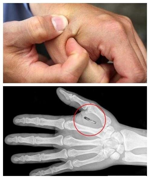 当黑客在体内植入9块芯片后，&ldquo;终结者&rdquo;要来了？